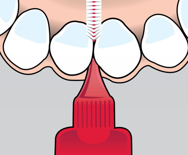 牙缝刷清洁齿缝